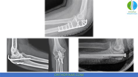 Olecranon Fracture - Easy Explained | OrthoFixar 2025