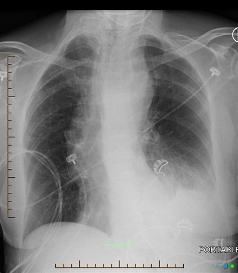 X Ray Images Of Aortic Tear