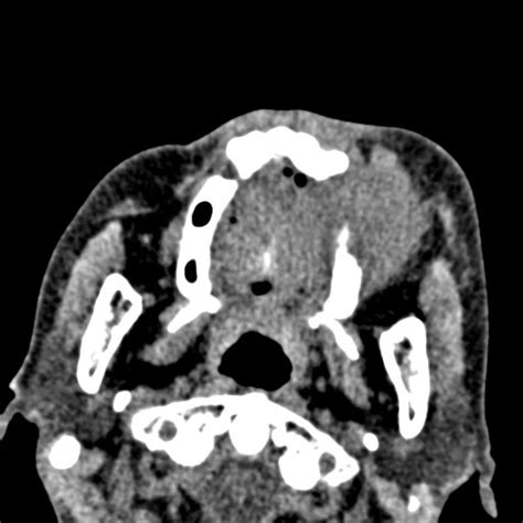 Maxillary Sinus Squamous Cell Carcinoma Image