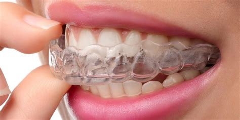 Orthodontie On Fait Le Point Sur Les Appareils Dentaires 2024