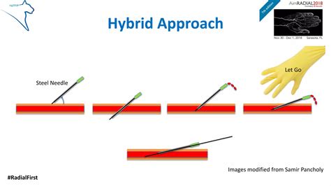 Pci And Aimradial 2018 Radial Artery Puncture Ian C Gilchrist Ppt