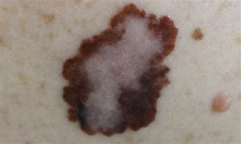 what does a malignant mole look like | Symptoms and pictures