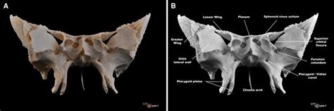 Photography Anterior View Of The Sphenoid Bone This Anterior View