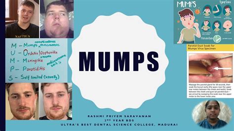 Mumps Clinical Features Effects Complications Diagnosis Management Prevention Mmr