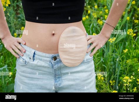 Close Up Of Woman Body After Of Colon Cancer In Springtime Ostomy Bag