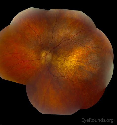 Atlas Entry Pattern Dystrophy