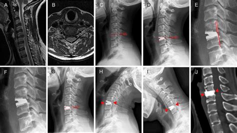 A Year Old Male Who Underwent Prestige Lp Cervical Arthroplasty At