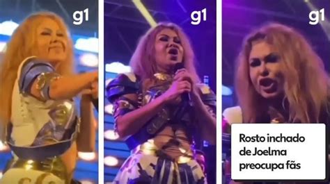 Joelma rosto inchado em show preocupa fãs são sequelas da Covid