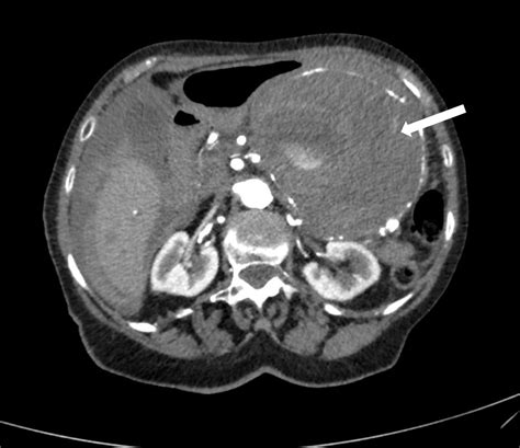 Emergency Endovascular Coiling Of A Ruptured Giant Splenic Artery Aneurysm Journal Of Vascular