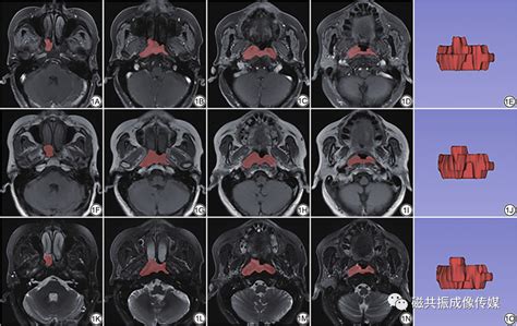 基于多参数mri影像组学联合临床影像特征预测鼻咽癌肿瘤细胞增殖活性 哔哩哔哩