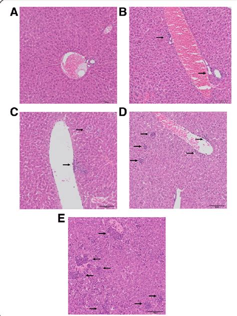 Extensive Extramedullary Haematopoiesis In The Liver During Cancer