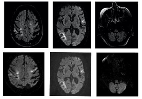 Axial T2 Flair Sequence 1 Top Revealing Acute And Subacute Lesions Download Scientific