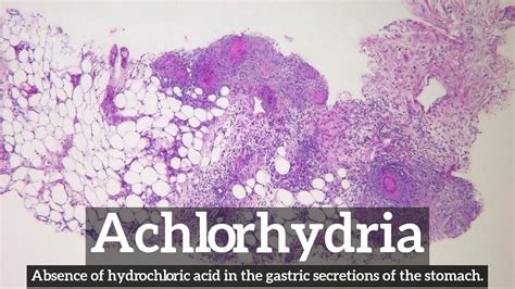 How Does Achlorhydria Look? | How to Say Achlorhydria in English? | What is Achlorhydria? - YouTube