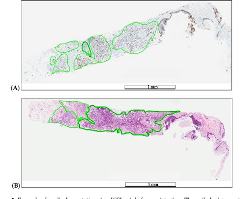 Figure From Detection Of Ki Hot Spots Of Invasive Breast Cancer