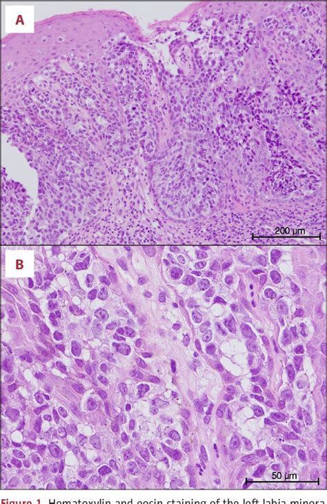 Figure 1 From Vulvar Extramammary Paget Disease Detected By Cytology