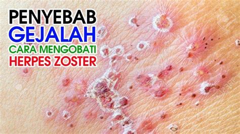 Kenali Penyebab Dan Gejala Penyakit Herpes Zoster Serta Cara