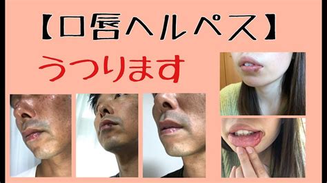 【口唇ヘルペス治し方】口唇ヘルペスの原因・症状・治療法〜唇が痛い・口唇ヘルペスはうつります〜【千葉市整体院「快」】 Youtube