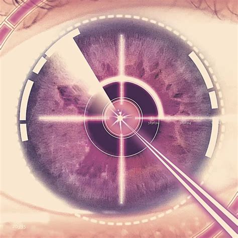 Prk Eye Surgery Recovery Timeline What To Expect Eyefacts