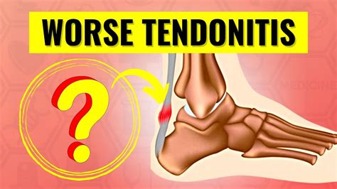 This is What CAUSES and WORSENS Tendonitis