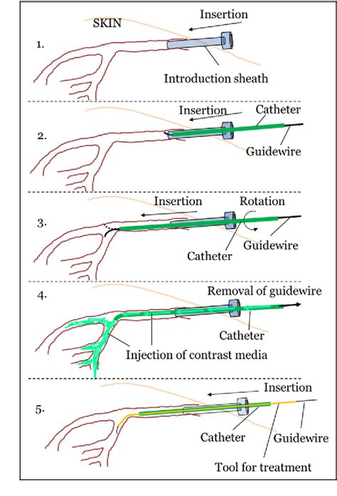 An Assembly Type Masterslave Catheter And Guidewire Driving System For Vascular Intervention