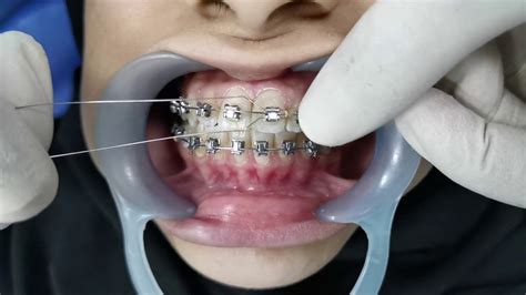 Orthodontic Ligation Youtube