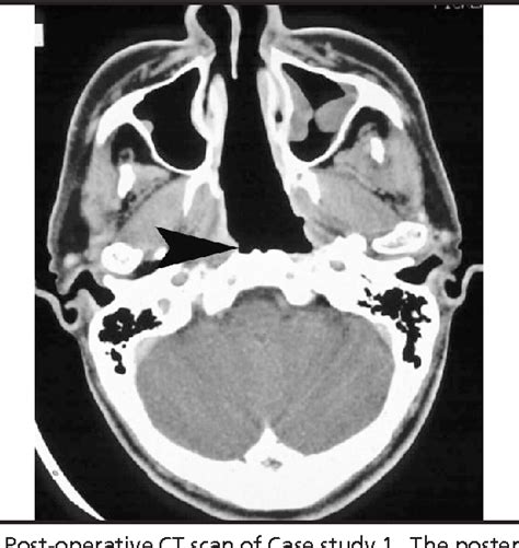 Figure From Long Term Results Of Endoscopic Resection Of