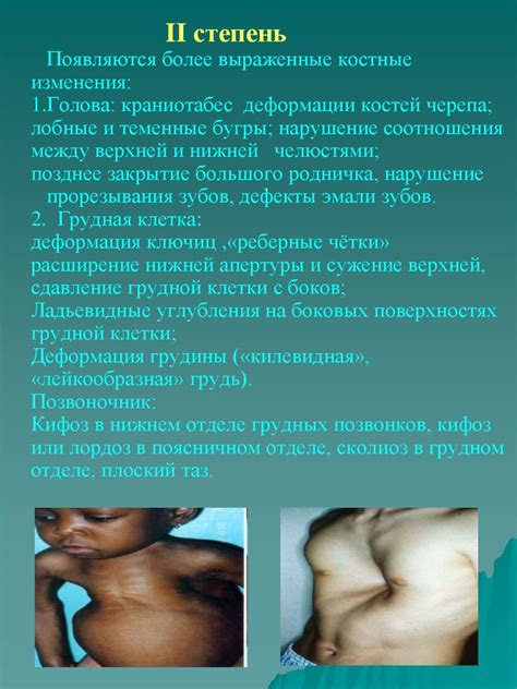 Рахит у детей - презентация онлайн