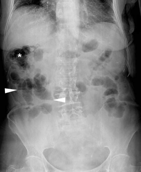 Iatrogenic Colon Perforation During Operative Colonoscopy Imaging Triage Eurorad