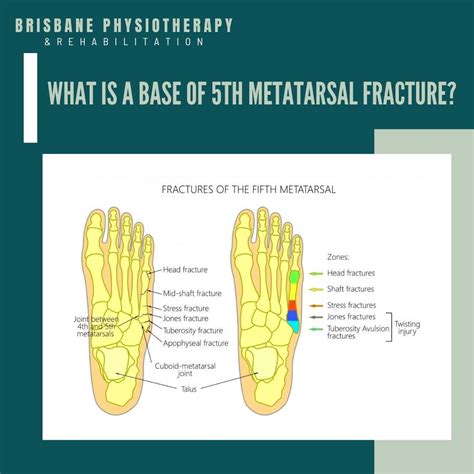 What Is A Base Of 5th Metatarsal Fracture Brisbane Physiotherapy