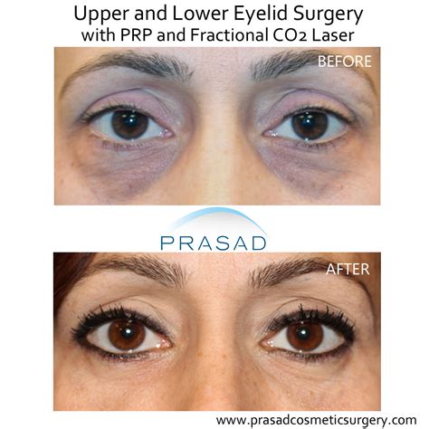 Laser Eyelid Lift