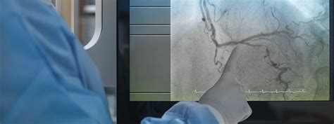 More Work Required On Non Type 1 Myocardial Infarction Subgroups