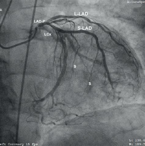 A B Coronary Angiogram Right Anterior Oblique Caudal Projection A