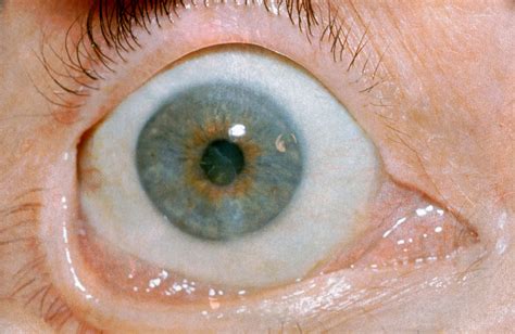 Medical Advancements In The Treatment Of Neurotrophic Keratitis Ophthalmology Advisor