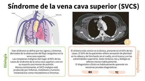 Teleterapia En S Ndrome De Compresi N De La Vena Cava Superior