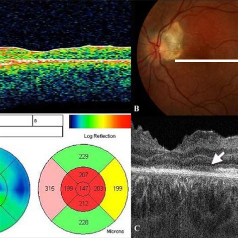 A Stratus Optical Coherence Tomography OCT Image OS Of Case 2 4