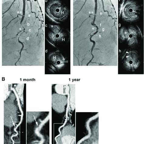 Angiograms And Serial Intravascular Ultrasound Ivus Images Before And Download Scientific