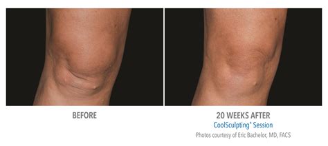 Coolsculpting Before and After Photos | Woodbridge, Vaughan