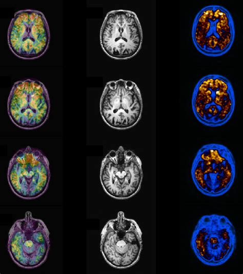 Abnormal Pib Pet Imaging A Patient With Confirmed Clinical Diagnosis Of