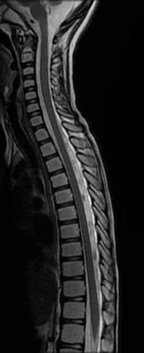 Area Postrema Syndrome Image