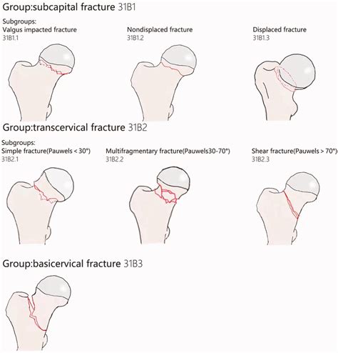 In The New Ao Classification Type B Is Femoral Neck Fracture Fnf