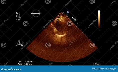 Ultrasound Transesophageal Examination Of The Heart Royalty Free Stock