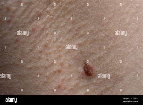 Photo Of Humans Skin Texture With Nevus Macro Shooting Stock Photo