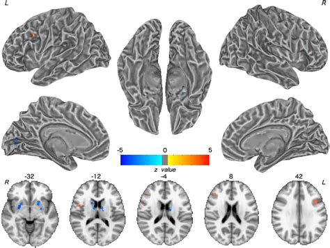 Frontiers Aberrant Coupling Between Resting State Cerebral Blood Flow