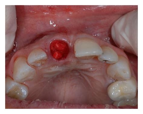 Alveolar Socket