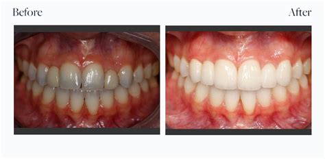 Before And After Downtown Dental Centre Toronto