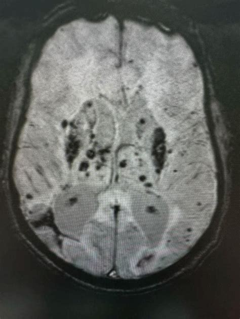 Hypertensive Microangiopathy in 2024 | Radiology, Case