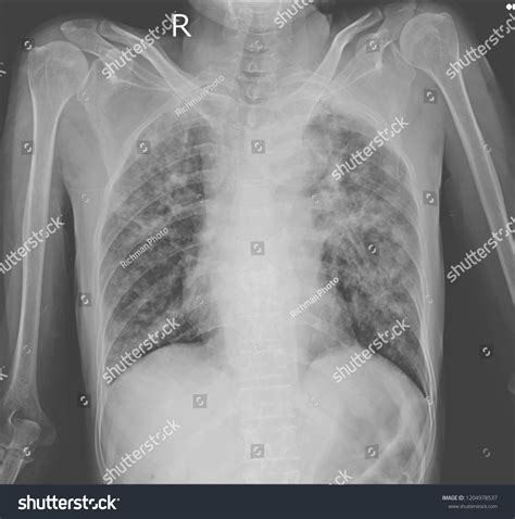 Chest Xray Showing Interstitial Pulmonary Infiltration Foto Stock