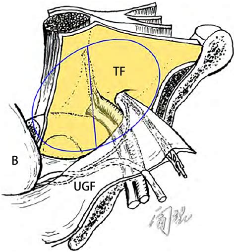 Distribution Of The Ugf In The Preperitoneal Space Ugf Urogenital