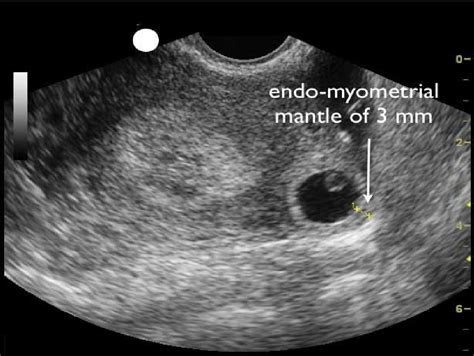 Figure 1 from 15 Modern Management of Cornual Ectopic Pregnancy | Semantic Scholar