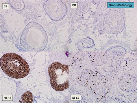 Qiao S Pathology Pleomorphic Lobular Carcinoma In Situ Plcis Of The